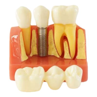 4× Dental Implant vs Bridge Model – Style 1