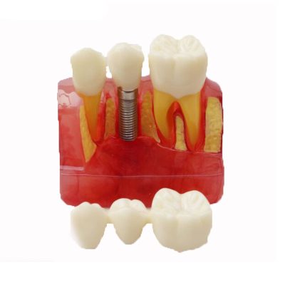 4× Dental Implant vs Bridge Model – Style 2