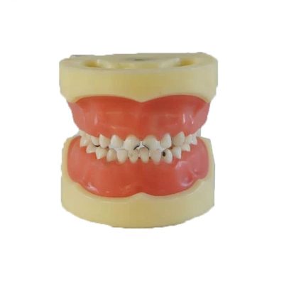 Child Dental Caries Model – Removable Gum