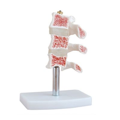 Cutaway Osteoporosis Model – 3 Lumbar Vertebrae