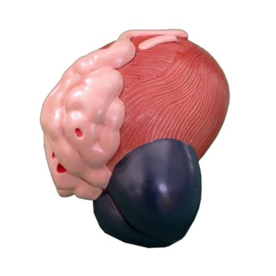 Enlarged Male Bladder & Prostate Model