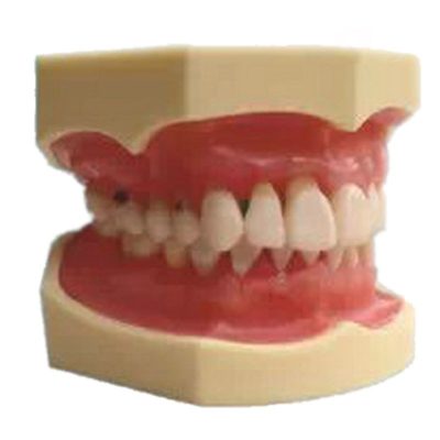 Periodontal Disease Comparison Model – Healthy vs Recession