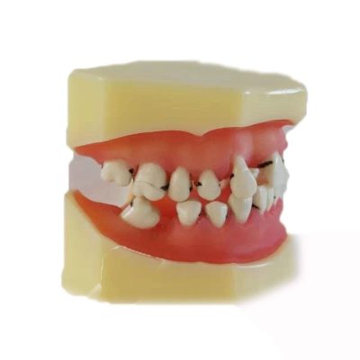 Periodontal Disease Model – Removable Gingiva
